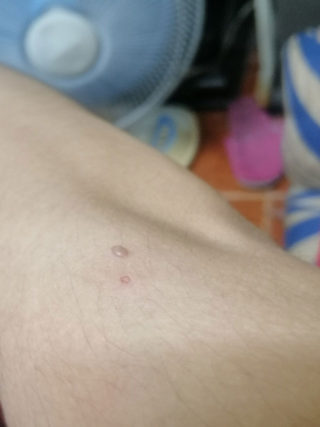 sana po matulungan nyo ako. chicken pox po ba yan? 13 weeks po ako. hindi po sya makati pero natatakot ako para sa baby ko.