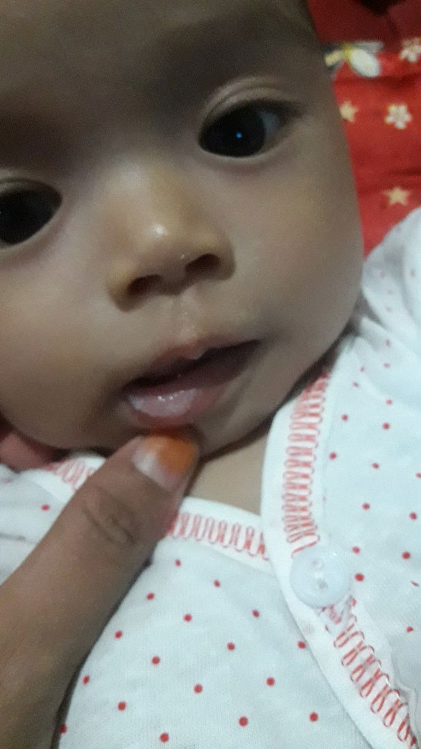 bibir bayi putih