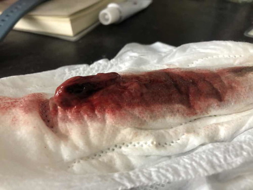 ติดเชื้อหลังแท้ง