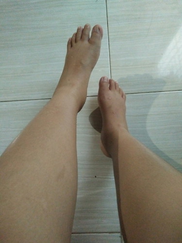 kaki bengkak