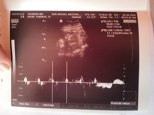 Placental Previa Grade 1 and Breech position.