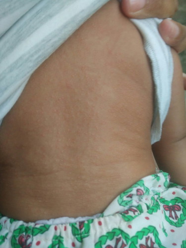 mengatasi biang keringat