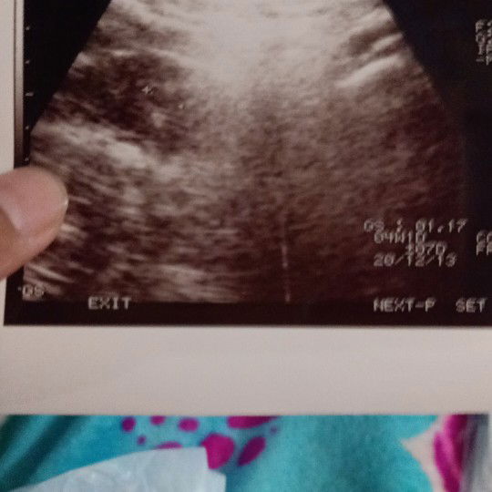 hasil usg membingungkan