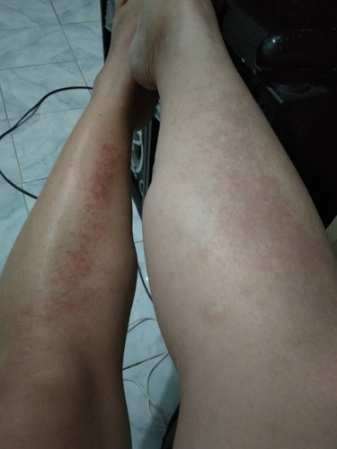allergy