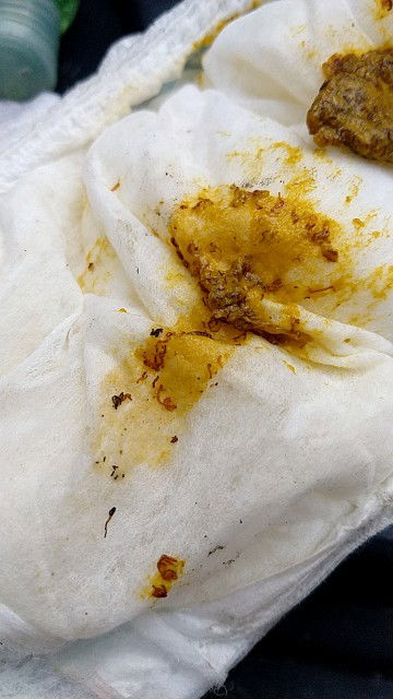 ลูกถ่ายผิดปกติ