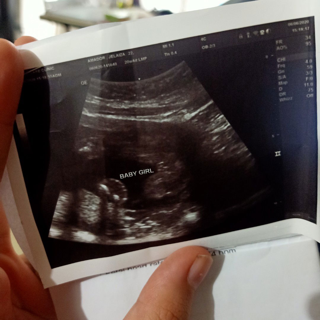 Accuracy ng Ultrasound