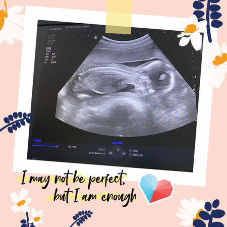 อยากถามคุณแม่ว่าจุดกลมๆสีขาวตรงหัวน้องมันคืออะไรคะอยากทราบแม่คนไหนเจอแบบนี้บางตอนนี้อายุครรภ์5เดือน