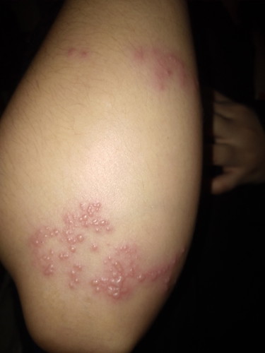 rashes