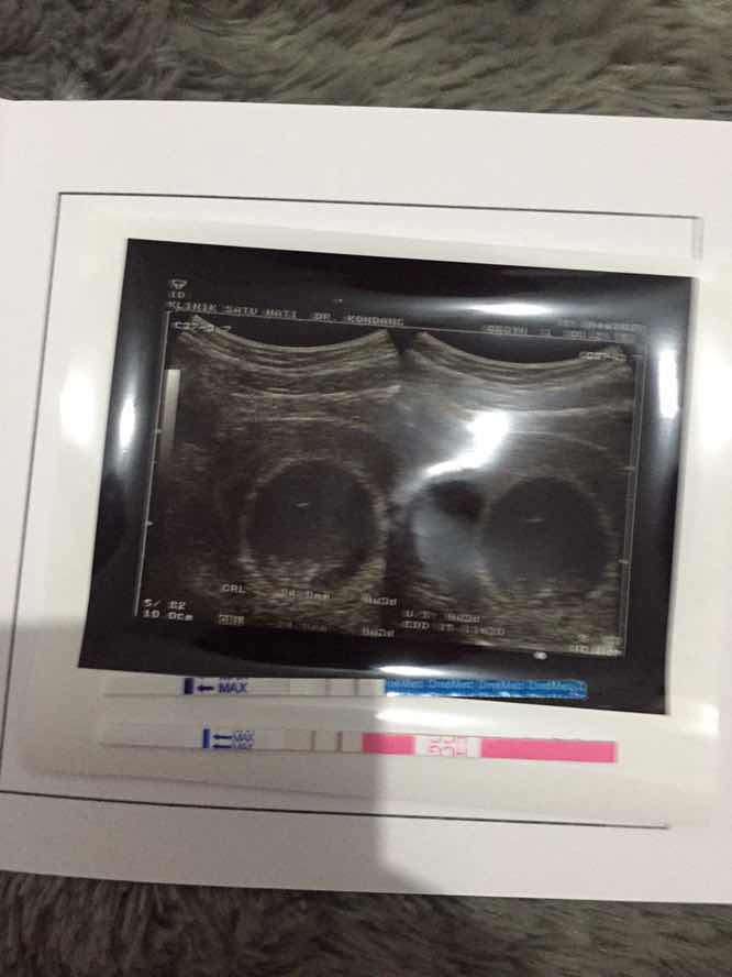 Tanya usg dong bun??