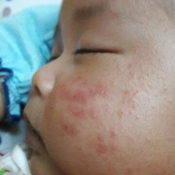 ผื่น