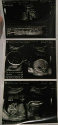 ultrasound