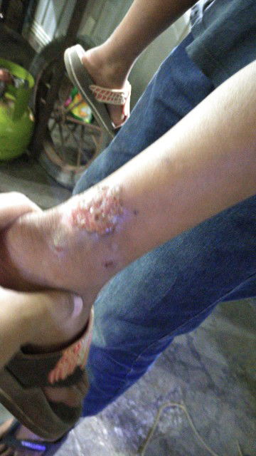 salep atau obat apakah yang baiknya di gunakan