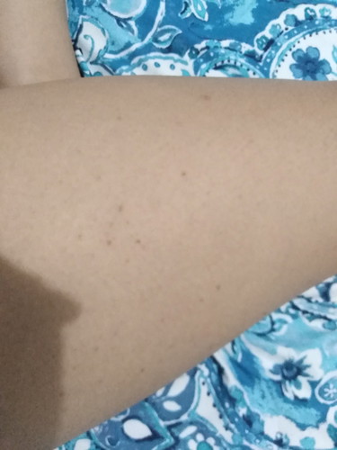 Skin Problem During Pregnancy