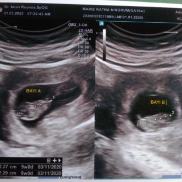 kehamilan kembar