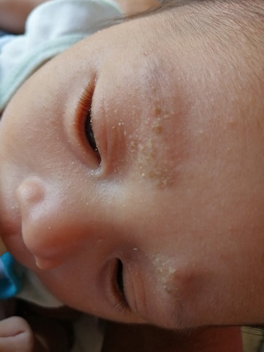 Skin Problem