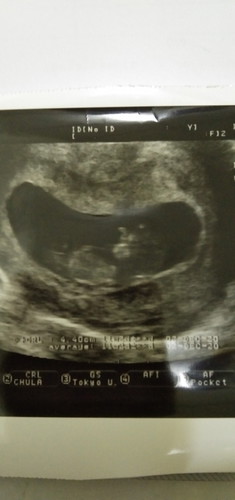 ฉีดวัคชีล