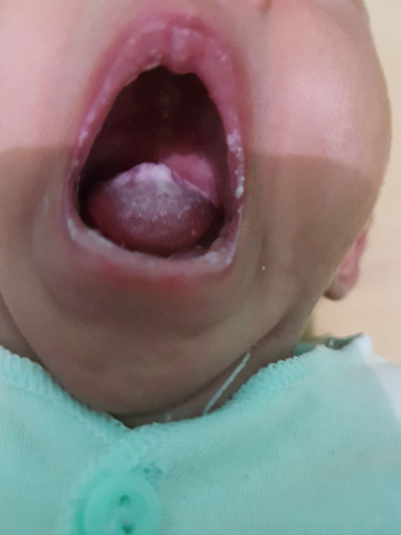 bibir bayi dan lidah putih