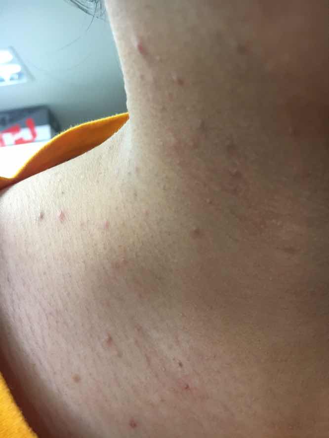 สิวขึ้นที่คอ เยอะๆมาก ปกติไหมค่ะแม่ๆ