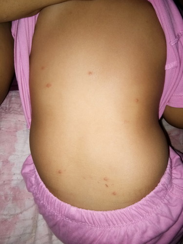 ผื่นคัน