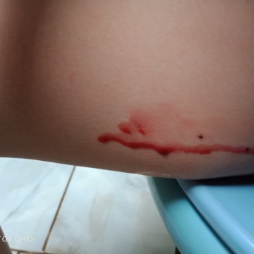 มีเลือดออก