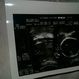 Menanyakan hasil usg