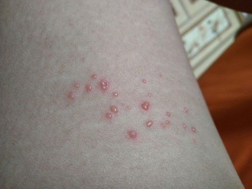 bintik merah berisi cairan