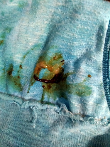 BROWN DISCHARGE