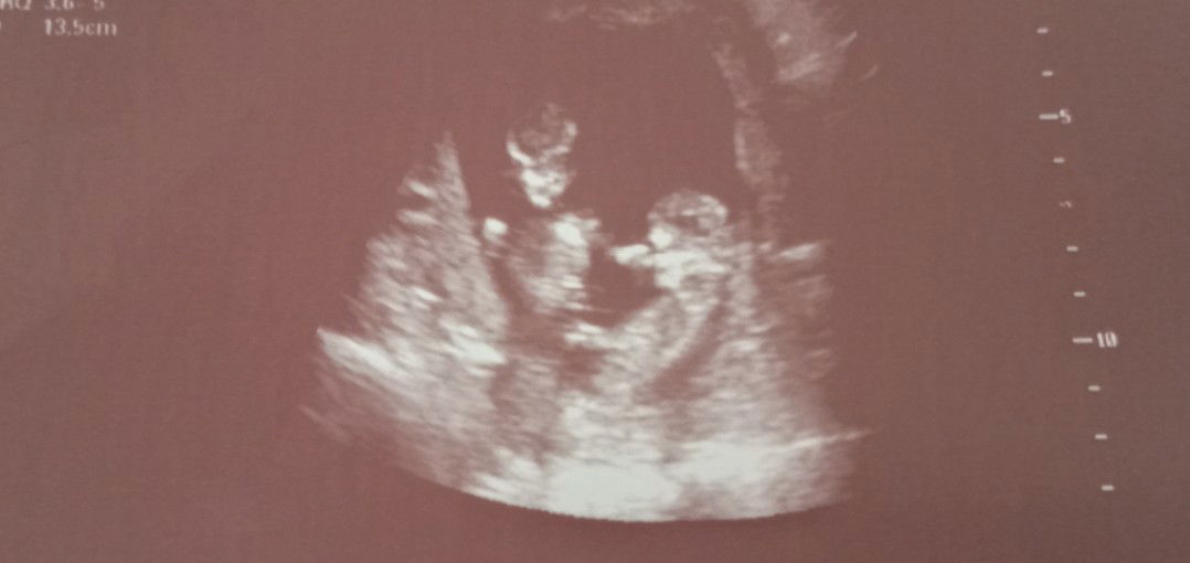 About Monochorionic Twin Pregnancy