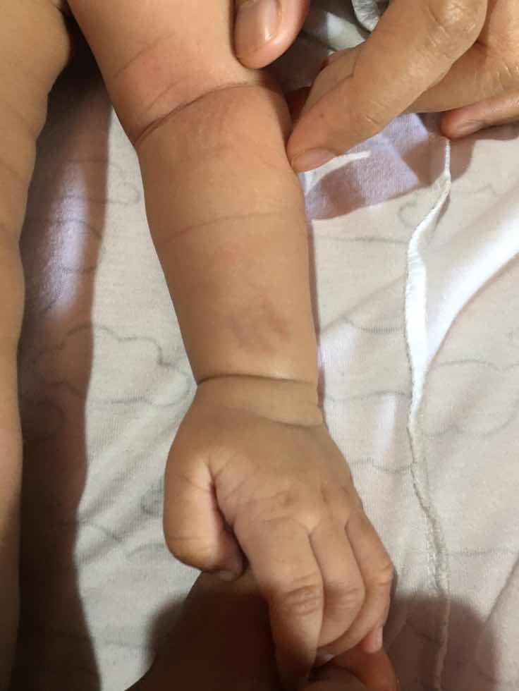 Memar pada tangan bayi