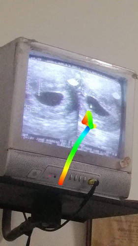 Normal Po Bang Hindi Pa Makita Ang Bata Sa Trans V