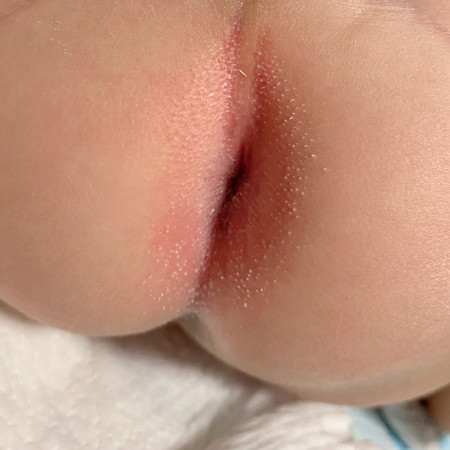 Baby ass-hole white bump
