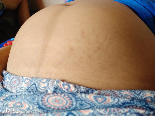 kamot stretch mark