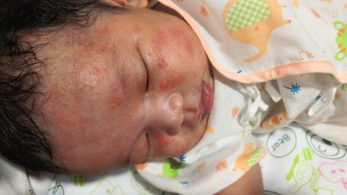 ลูกบ้านไหนเป็นผื่นแดงแบบนี้บ้างค่ะ ตอนนี้ขึ้นเต็มหน้าเต็มตัวไปหมดแร้วค่ะ ลูกแพ้อะไรหรือป่าวหรือว่าเป็นปกติของเด็กค่ะ