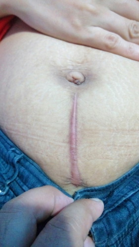 scars