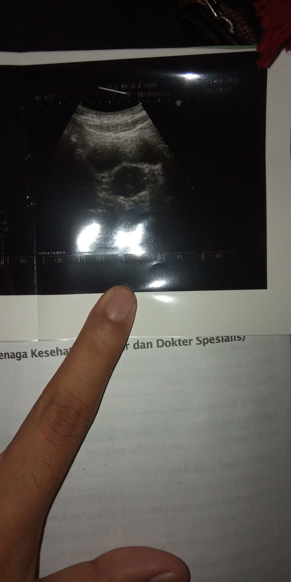 Kemungkinan Hamil Anggur