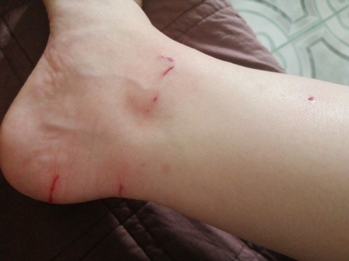 Anti Rabies