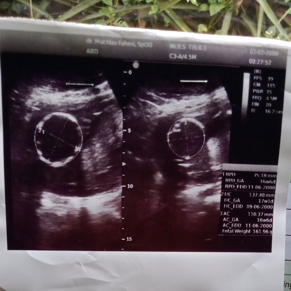 usia brp bulan ketauan jenis kelamin bayi?