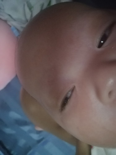 ลูก3เดือนตาแฉะ