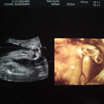 ขอดูภาพอัลตร้าซาวด์แม่ที่ได้ลูกสาวหน่อย