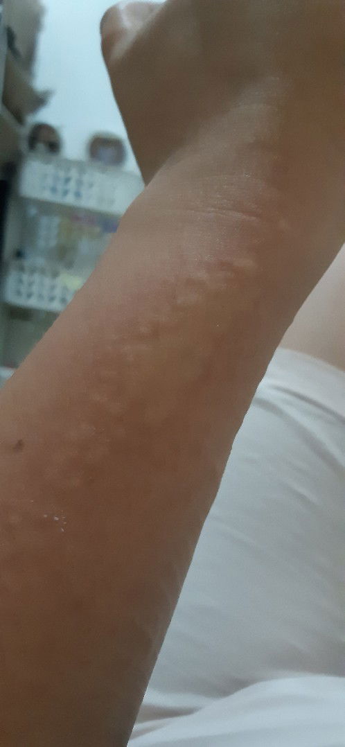 Gatal² Sampai timbul bentol² ukuran besar