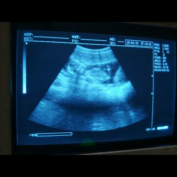 usg di 3 bulan kehamilan