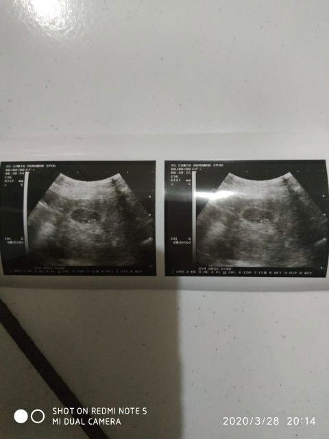 masih bingung hasil. usg