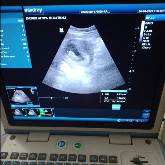 hpht dan usg selisih