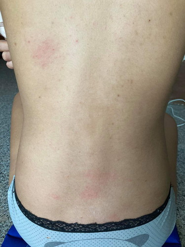 เป็นผื่นคัน