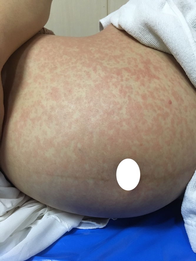 โรคหัด/หัดเยอรมันคุณแม่ต้องระวัง (1)