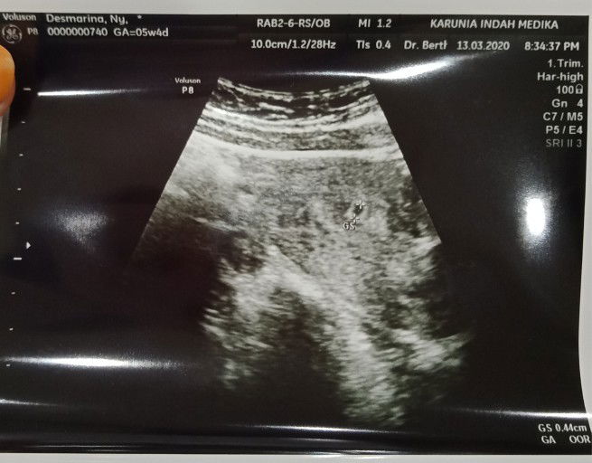 Perut kembung mules kayak mau BAB