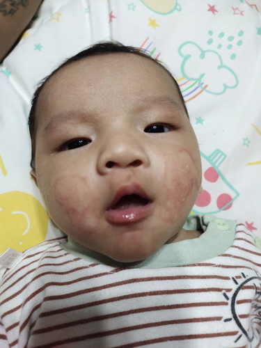ลูกมีผดขึ้นที่แก้ม