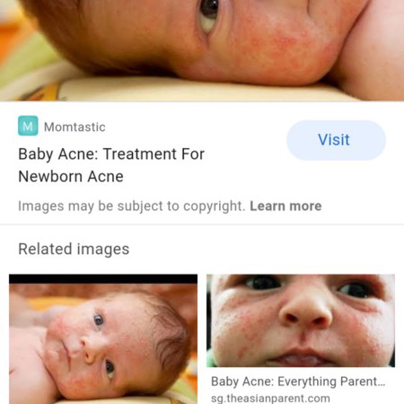 baby acne