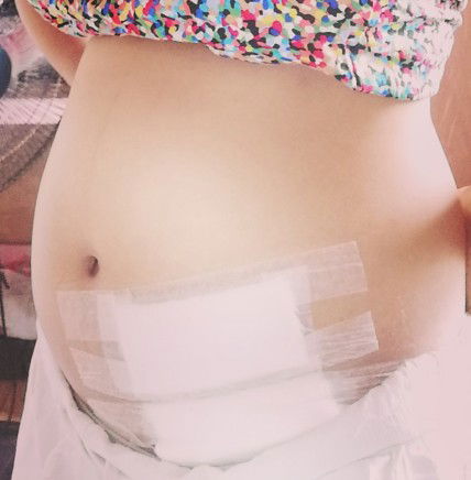 Help! Bubuka Ba Ang Sugat Ko?