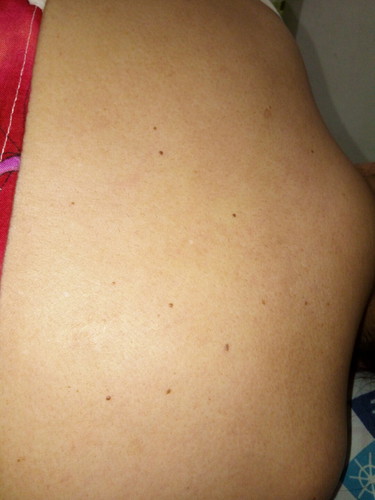 warts